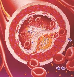 Narrowed artery due to cholesterol