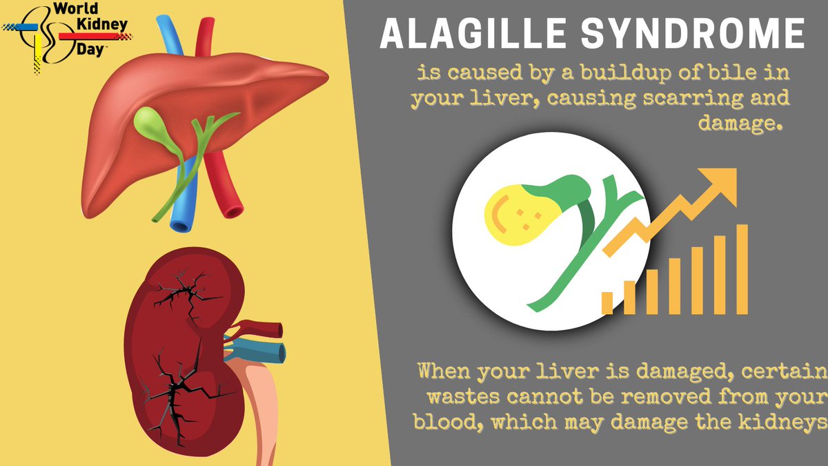 la sindrome di Alagille è causata da una mutazione che impedisce la formazione e la rigenerazione dei dotti biliari nel fegato
