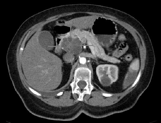 Immagine TC assiale con contrasto iv. Adenocarcinoma macrocistico della testa del pancreas. 