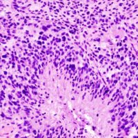 I farmaci ansiolitici possono migliorare le possibilità di sopravvivenza al cancro al cervello