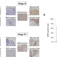 Un nuovo marcatore tumorale è in grado di rilevare il cancro gastrointestinale con una precisione pari quasi al 90%.