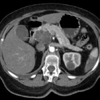 Un nuovo approccio al trattamento del cancro al pancreas espande le possibilità terapeutiche e promette di aumentare la sopravvivenza