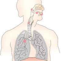 La genetica dei tessuti sani vicini può aiutare a individuare il ritorno del cancro ai polmoni