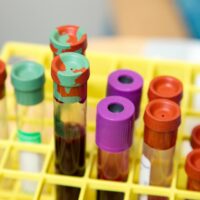 scienziati scoprono proteine ​​del sangue che potrebbero dare l’allarme sul cancro sette anni prima della diagnosi