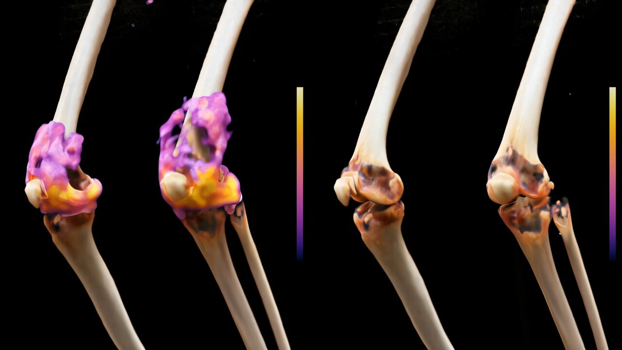 Le cellule immunitarie dei pazienti, geneticamente modificate in laboratorio, individuano le cellule B responsabili della malattia, anche in profondità nei tessuti. I focolai infiammatori, come quelli visibili qui intorno alle articolazioni del ginocchio di un partecipante allo studio (in magenta), non sono più rilevabili nemmeno diversi mesi dopo la terapia con cellule T CD19-CAR (a destra nell'immagine PET-MRI). Gonfiore e dolore si sono attenuati, con un miglioramento della mobilità. Crediti: Charité | David Simon