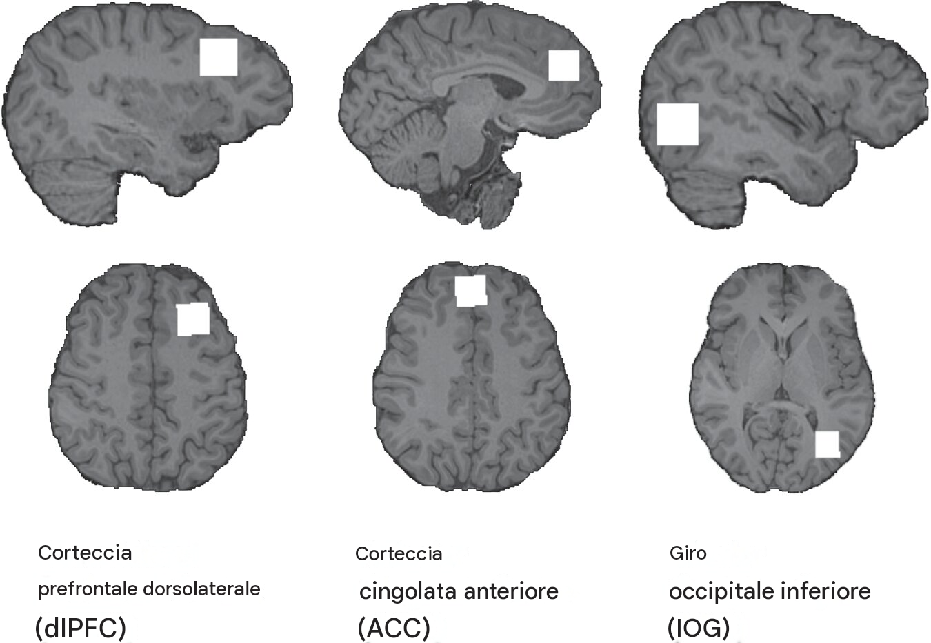 Esempio di posizionamento dei voxel ¹H-MRS in ciascuna regione di interesse. Fonte: Molecular Psychiatry (2026). DOI: 10.1038/s41380-026-03813-y