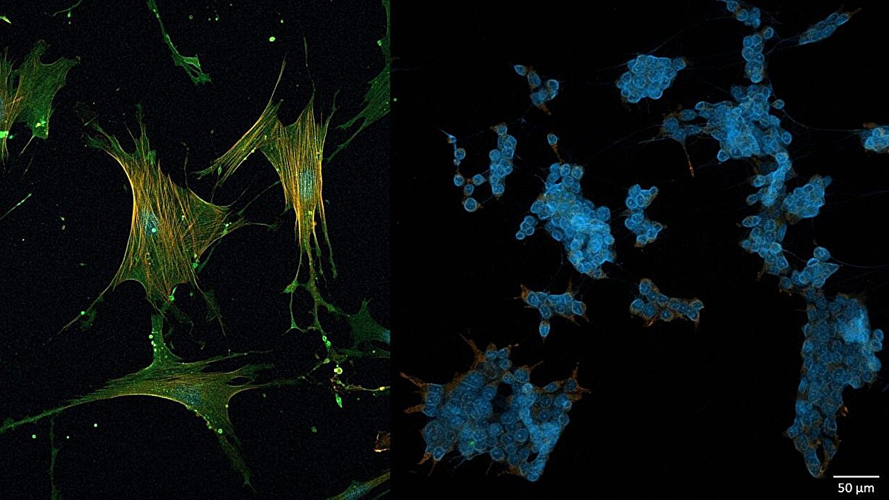 La proteina CD44 (in verde) attiva i fibroblasti associati al cancro. Quando la molecola viene inattivata (a destra), le cellule cambiano forma e perdono il loro stato di attivazione. Fonte: Treffert et al./KIT